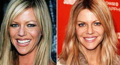 kaitlin olsen plastic surgery|Kaitlin Olsons Plastic Surgery